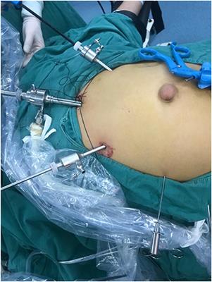 Case Report: 21 Cases of Umbilical Hernia Repair Using a Laparoscopic Cephalic Approach Plus a Posterior Sheath and Extraperitoneal Approach